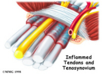Inflammed tentons