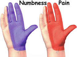 Hands showing areas of numbness and pain
